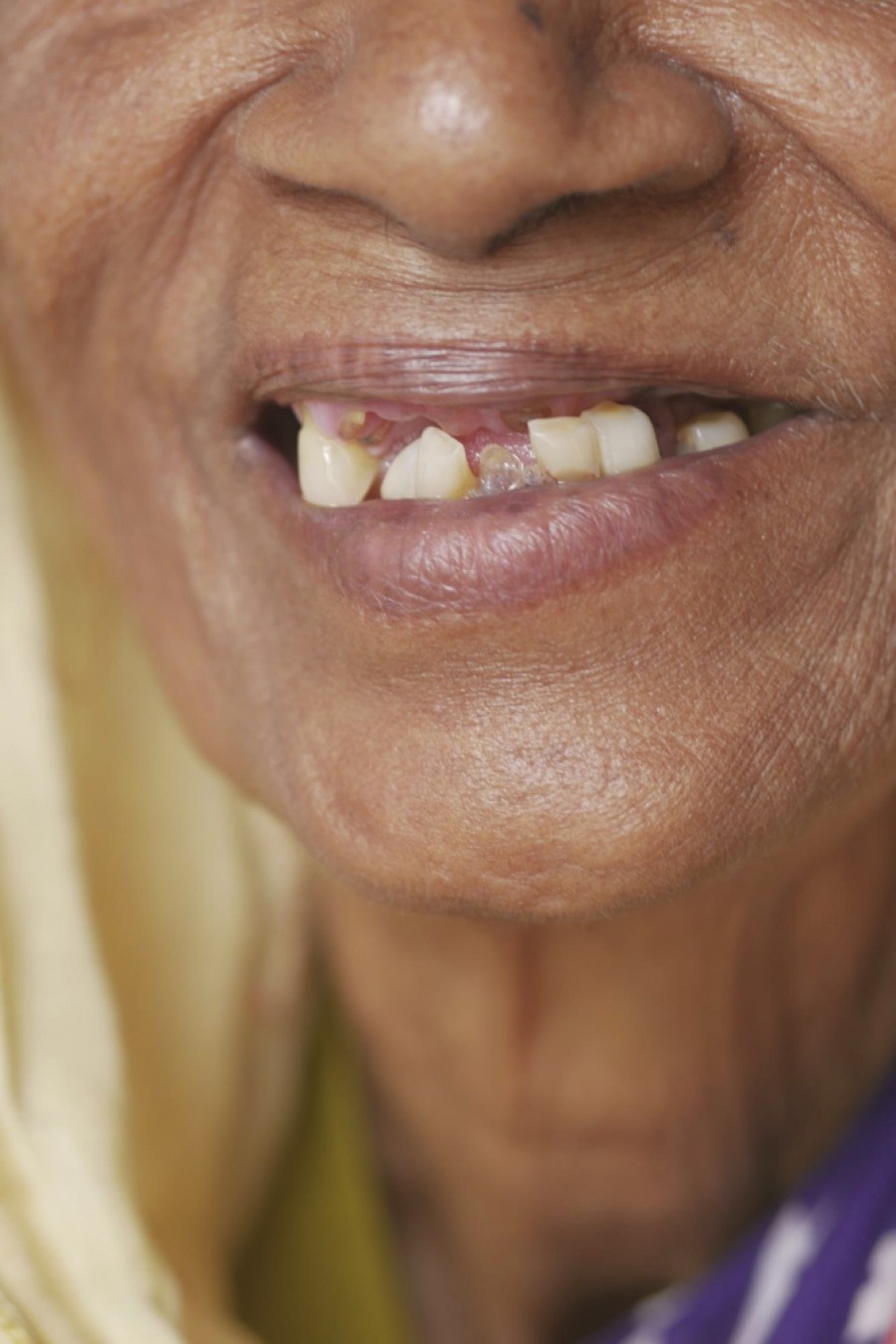 Edentulia e Salute Cognitiva: Perché Prendersi Cura dei Denti in Età Avanzata è Fondamentale