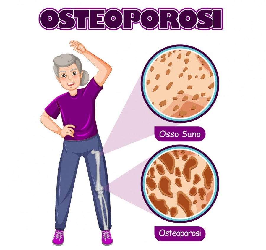Osteoporosi: cos'è?